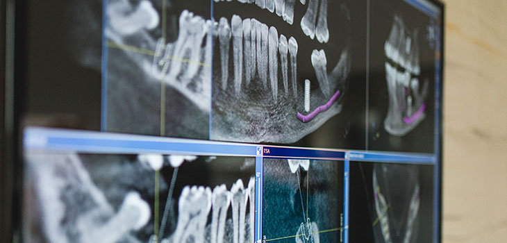 Zahn­implantate Dorsten: „neue Zähne“ für festen Biss